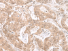 Immunohistochemistry of paraffin-embedded Human gastric cancer tissue  using ETV3 Polyclonal Antibody at dilution of 1:25(×200)