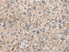 Immunohistochemistry of paraffin-embedded Human liver cancer tissue  using HLA-DRA Polyclonal Antibody at dilution of 1:30(×200)