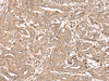 Immunohistochemistry of paraffin-embedded Human liver cancer tissue  using FAAP24 Polyclonal Antibody at dilution of 1:30(×200)