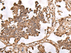 Immunohistochemistry of paraffin-embedded Human lung cancer tissue  using FAAP24 Polyclonal Antibody at dilution of 1:30(×200)