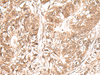 Immunohistochemistry of paraffin-embedded Human gastric cancer tissue  using USP16 Polyclonal Antibody at dilution of 1:25(×200)