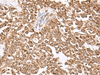 Immunohistochemistry of paraffin-embedded Human ovarian cancer tissue  using USP16 Polyclonal Antibody at dilution of 1:25(×200)