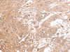 Immunohistochemistry of paraffin-embedded Human esophagus cancer tissue  using CHST4 Polyclonal Antibody at dilution of 1:35(×200)
