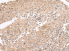 Immunohistochemistry of paraffin-embedded Human cervical cancer tissue  using PATJ Polyclonal Antibody at dilution of 1:45(×200)