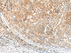 Immunohistochemistry of paraffin-embedded Human cervical cancer tissue  using KCNA10 Polyclonal Antibody at dilution of 1:40(×200)