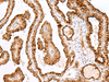 Immunohistochemistry of paraffin-embedded Human thyroid cancer tissue  using SAXO2 Polyclonal Antibody at dilution of 1:40(×200)