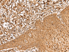 Immunohistochemistry of paraffin-embedded Human esophagus cancer tissue  using FAM200A Polyclonal Antibody at dilution of 1:55(×200)