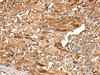 Immunohistochemistry of paraffin-embedded Human cervical cancer tissue  using PIEZO2 Polyclonal Antibody at dilution of 1:55(×200)