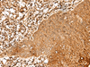 Immunohistochemistry of paraffin-embedded Human esophagus cancer tissue  using FAM50A Polyclonal Antibody at dilution of 1:25(×200)