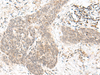 Immunohistochemistry of paraffin-embedded Human esophagus cancer tissue  using FAM84B Polyclonal Antibody at dilution of 1:70(×200)