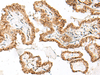 Immunohistochemistry of paraffin-embedded Human thyroid cancer tissue  using FAM84B Polyclonal Antibody at dilution of 1:70(×200)