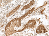 Immunohistochemistry of paraffin-embedded Human esophagus cancer tissue  using FANCB Polyclonal Antibody at dilution of 1:25(×200)