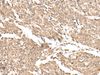 Immunohistochemistry of paraffin-embedded Human lung cancer tissue  using KDM2A Polyclonal Antibody at dilution of 1:55(×200)