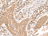 Immunohistochemistry of paraffin-embedded Human esophagus cancer tissue  using KDM2A Polyclonal Antibody at dilution of 1:55(×200)