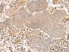Immunohistochemistry of paraffin-embedded Human esophagus cancer tissue  using FBXW8 Polyclonal Antibody at dilution of 1:65(×200)