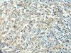 Immunohistochemistry of paraffin-embedded Human liver cancer tissue  using FCGRT Polyclonal Antibody at dilution of 1:45(×200)