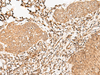 Immunohistochemistry of paraffin-embedded Human esophagus cancer tissue  using FER Polyclonal Antibody at dilution of 1:90(×200)