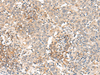 Immunohistochemistry of paraffin-embedded Human cervical cancer tissue  using SLC40A1 Polyclonal Antibody at dilution of 1:90(×200)