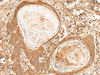 Immunohistochemistry of paraffin-embedded Human esophagus cancer tissue  using FIZ1 Polyclonal Antibody at dilution of 1:35(×200)