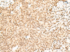 Immunohistochemistry of paraffin-embedded Human ovarian cancer tissue  using FKBP5 Polyclonal Antibody at dilution of 1:50(×200)