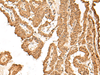 Immunohistochemistry of paraffin-embedded Human thyroid cancer tissue  using VPS50 Polyclonal Antibody at dilution of 1:45(×200)