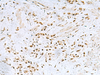 Immunohistochemistry of paraffin-embedded Human gastric cancer tissue  using FOXQ1 Polyclonal Antibody at dilution of 1:25(×200)