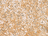 Immunohistochemistry of paraffin-embedded Human liver cancer tissue  using FAAP100 Polyclonal Antibody at dilution of 1:50(×200)