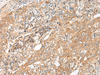 Immunohistochemistry of paraffin-embedded Human cervical cancer tissue  using GALP Polyclonal Antibody at dilution of 1:45(×200)