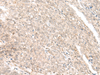 Immunohistochemistry of paraffin-embedded Human ovarian cancer tissue  using GANC Polyclonal Antibody at dilution of 1:45(×200)