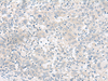 Immunohistochemistry of paraffin-embedded Human cervical cancer tissue  using RALGAPA1 Polyclonal Antibody at dilution of 1:55(×200)