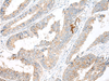 Immunohistochemistry of paraffin-embedded Human colorectal cancer tissue  using GARNL3 Polyclonal Antibody at dilution of 1:60(×200)