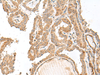 Immunohistochemistry of paraffin-embedded Human thyroid cancer tissue  using GART Polyclonal Antibody at dilution of 1:30(×200)