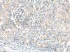 Immunohistochemistry of paraffin-embedded Human cervical cancer tissue  using GART Polyclonal Antibody at dilution of 1:30(×200)