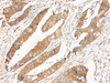 Immunohistochemistry of paraffin-embedded Human colorectal cancer tissue  using GBP4 Polyclonal Antibody at dilution of 1:30(×200)