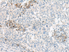 Immunohistochemistry of paraffin-embedded Human cervical cancer tissue  using GUCA1B Polyclonal Antibody at dilution of 1:45(×200)