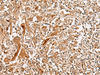 Immunohistochemistry of paraffin-embedded Human liver cancer tissue  using GCC2 Polyclonal Antibody at dilution of 1:45(×200)