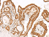 Immunohistochemistry of paraffin-embedded Human thyroid cancer tissue  using GRASP Polyclonal Antibody at dilution of 1:150(×200)