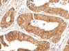 Immunohistochemistry of paraffin-embedded Human colorectal cancer tissue  using GFI1 Polyclonal Antibody at dilution of 1:100(×200)