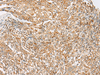 Immunohistochemistry of paraffin-embedded Human cervical cancer tissue  using MBOAT4 Polyclonal Antibody at dilution of 1:30(×200)