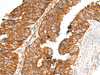 Immunohistochemistry of paraffin-embedded Human colorectal cancer tissue  using MBOAT4 Polyclonal Antibody at dilution of 1:30(×200)