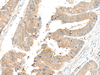 Immunohistochemistry of paraffin-embedded Human colorectal cancer tissue  using GLS2 Polyclonal Antibody at dilution of 1:45(×200)