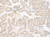 Immunohistochemistry of paraffin-embedded Human thyroid cancer tissue  using EPRS Polyclonal Antibody at dilution of 1:60(×200)
