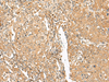 Immunohistochemistry of paraffin-embedded Human cervical cancer tissue  using GOLGA6A Polyclonal Antibody at dilution of 1:50(×200)