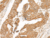 Immunohistochemistry of paraffin-embedded Human colorectal cancer tissue  using GOLGA6A Polyclonal Antibody at dilution of 1:50(×200)