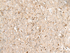 Immunohistochemistry of paraffin-embedded Human ovarian cancer tissue  using NUP210 Polyclonal Antibody at dilution of 1:30(×200)