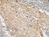 Immunohistochemistry of paraffin-embedded Human cervical cancer tissue  using GPR151 Polyclonal Antibody at dilution of 1:45(×200)