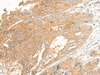 Immunohistochemistry of paraffin-embedded Human colorectal cancer tissue  using C5AR2 Polyclonal Antibody at dilution of 1:25(×200)