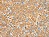 Immunohistochemistry of paraffin-embedded Human cervical cancer tissue  using P2RY14 Polyclonal Antibody at dilution of 1:25(×200)