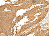 Immunohistochemistry of paraffin-embedded Human colorectal cancer tissue  using P2RY14 Polyclonal Antibody at dilution of 1:25(×200)