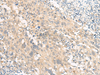 Immunohistochemistry of paraffin-embedded Human cervical cancer tissue  using GPR22 Polyclonal Antibody at dilution of 1:50(×200)